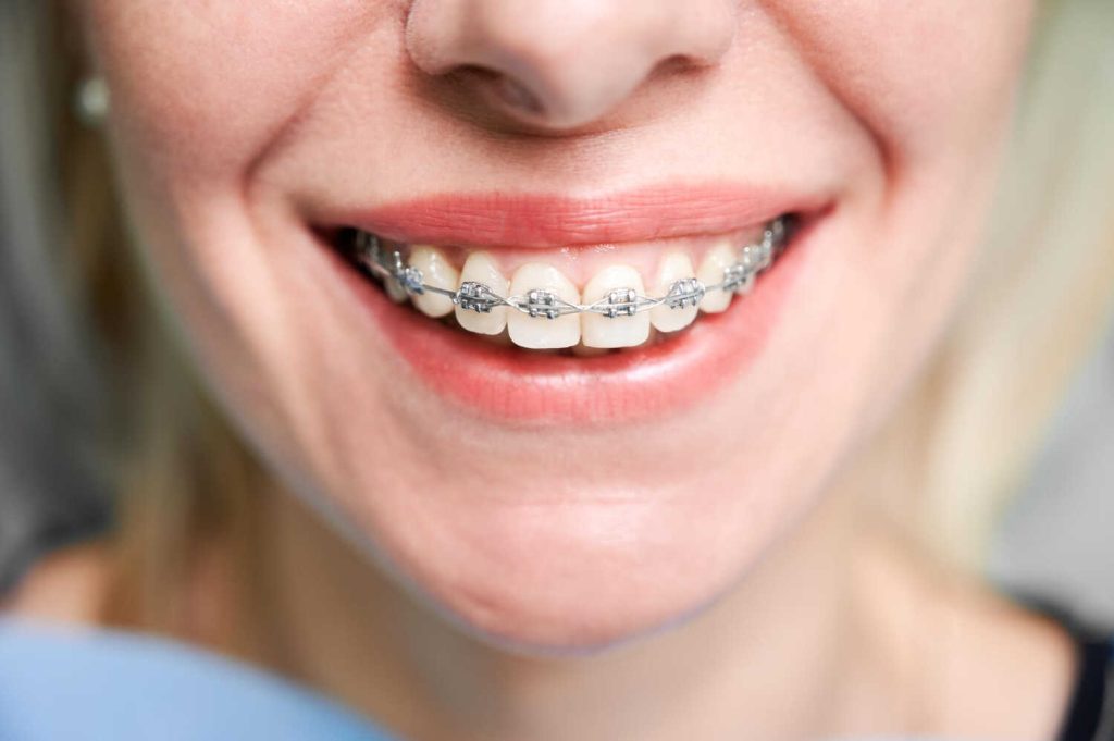 What are Lingual Braces?