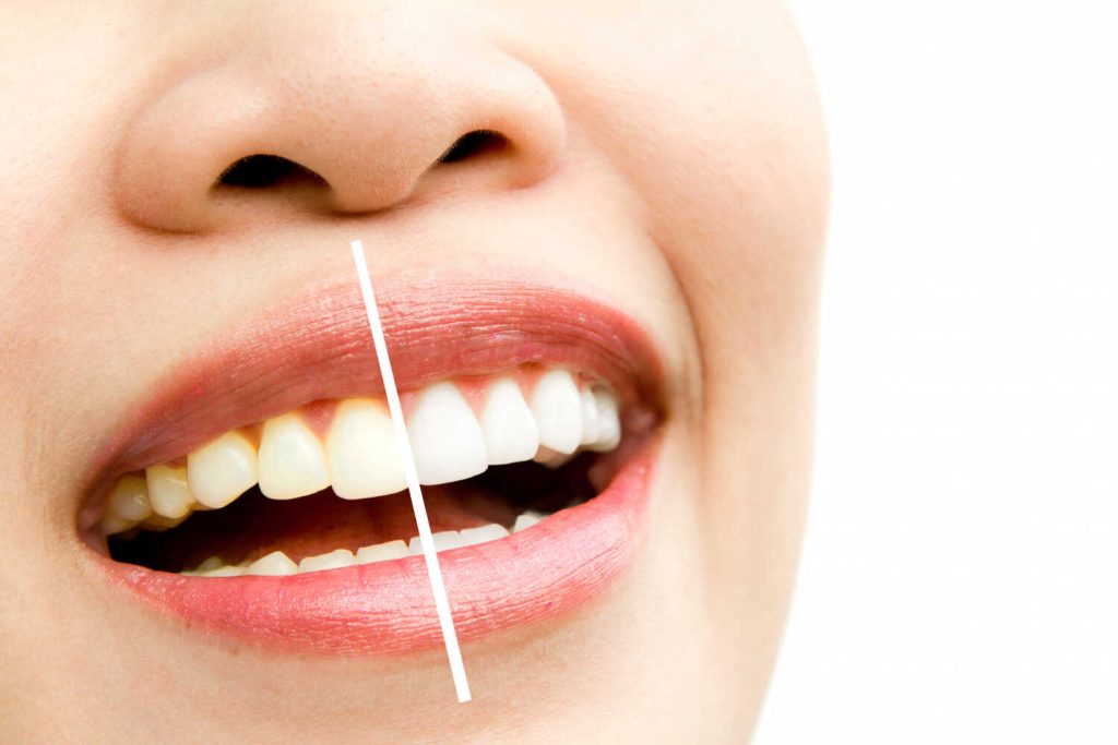 What to Expect at Your Richardson Teeth Whitening Clinic Appointment