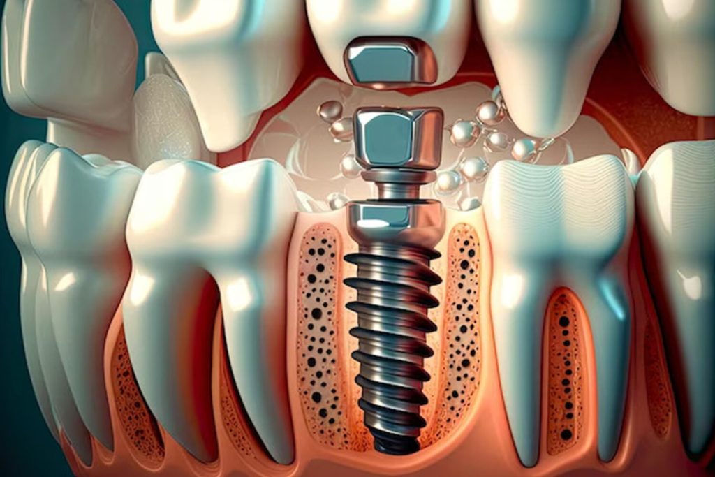 Dental Implant Clinic Richardson