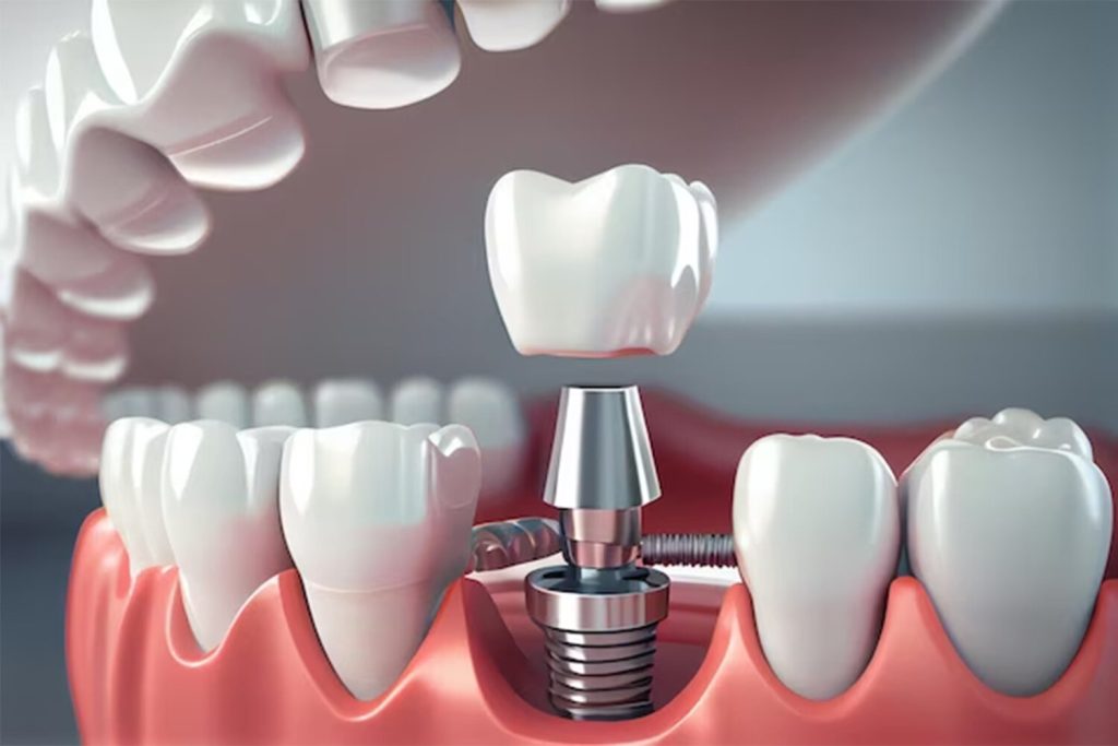 dental implants clinic richardson