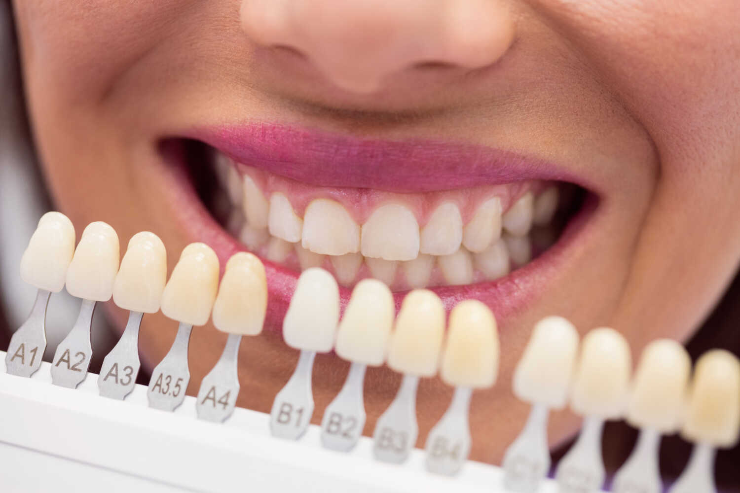 Teeth Whitening Damage Causes, Symptoms, and Treatment Options